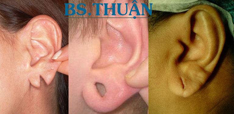 Địa chỉ thẩm mỹ vá lỗ tai, rách dái tai ở TPHCM giá rẻ