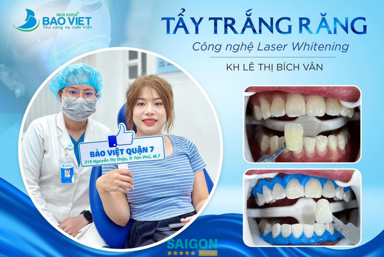 Dịch vụ tẩy trắng răng tại Nha Khoa Bảo Việt