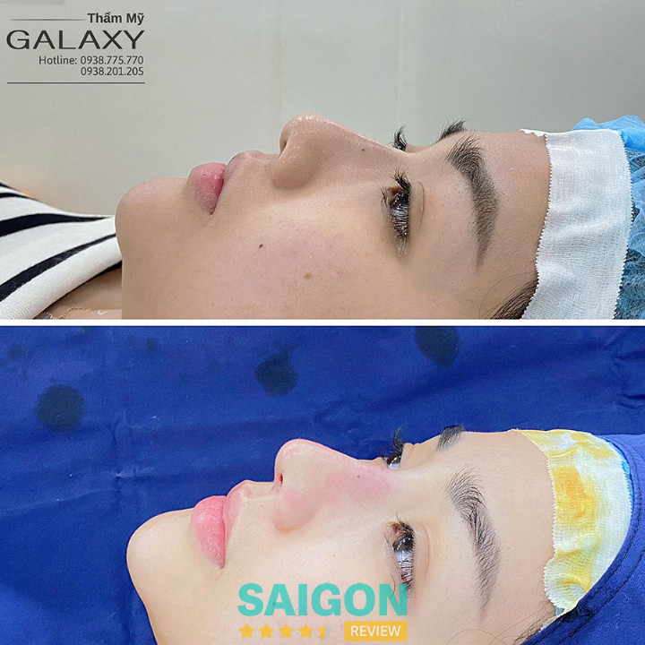 Nâng mũi cấu trúc thẩm mỹ galaxy bác sĩ lê trần duy