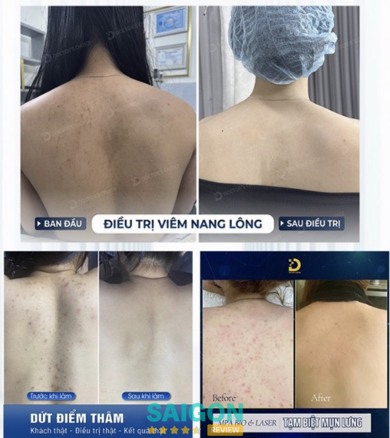 Trị mụn ở lưng uy tín nhất TPHCM