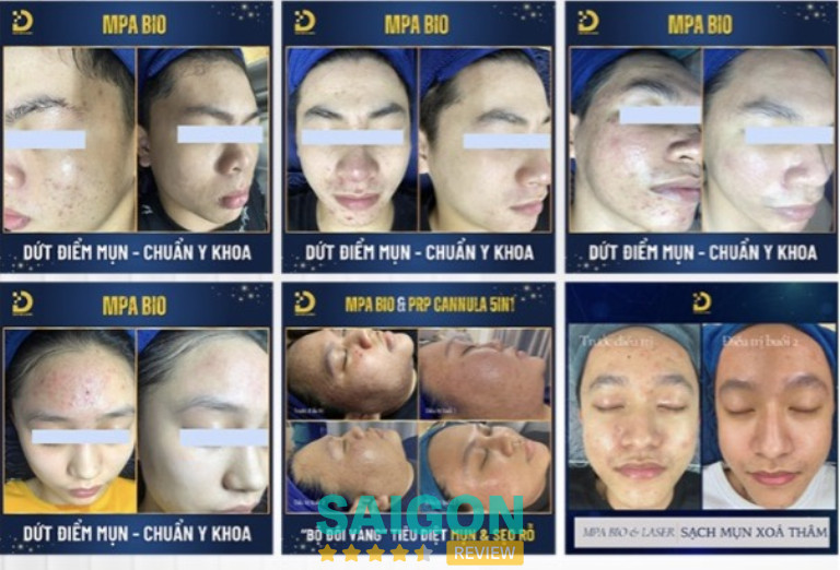 Trị thâm do mụn ở TPHCM dr choice Clinic uy tín ở TPHCM