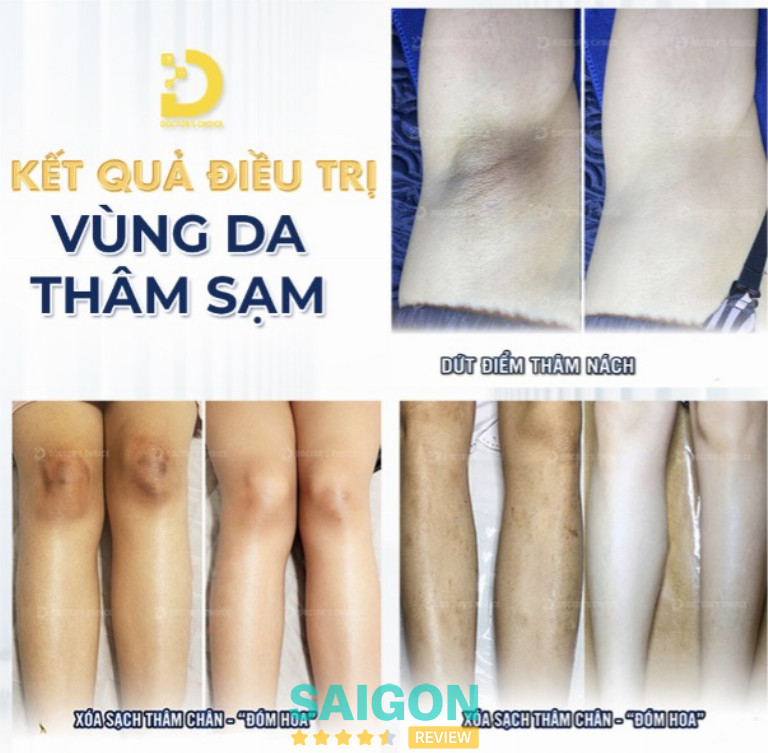 trị thâm nách mông bẹn ở tphcm dr choice uy tín