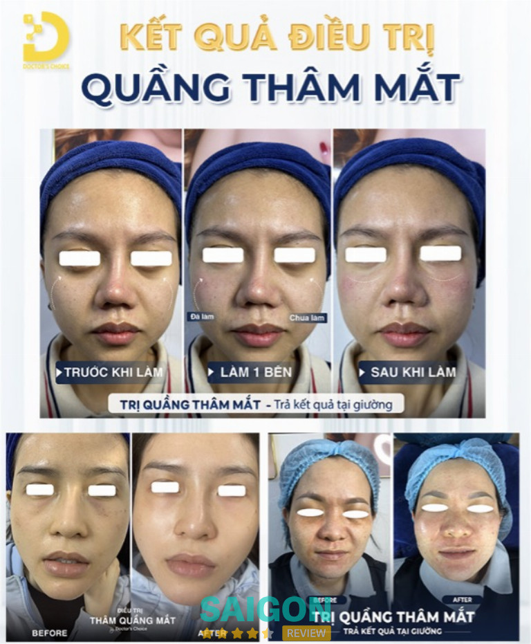 trị thâm quầng mắt ở tphcm uy tín dr choice clinic