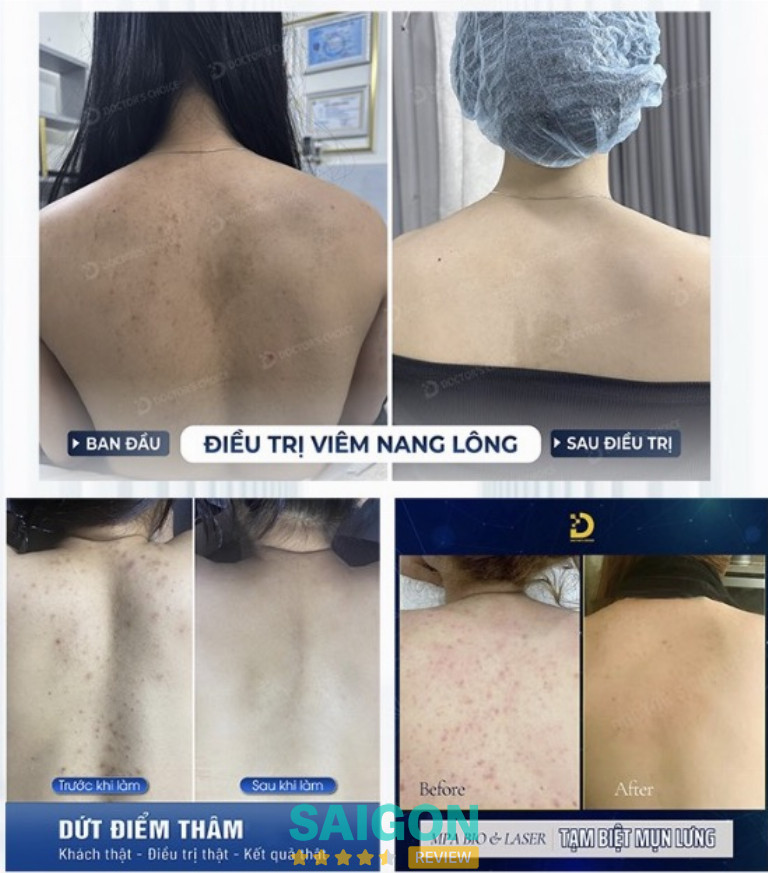 Kết quả trị viêm nang lông ở dr choice clinic