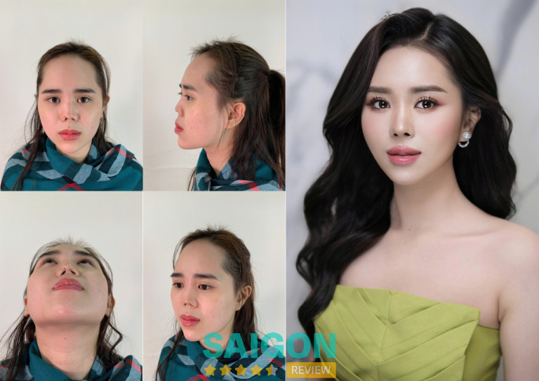 Bác sĩ Nguyễn Tiến Huy sửa mũi hỏng tại TPHCM