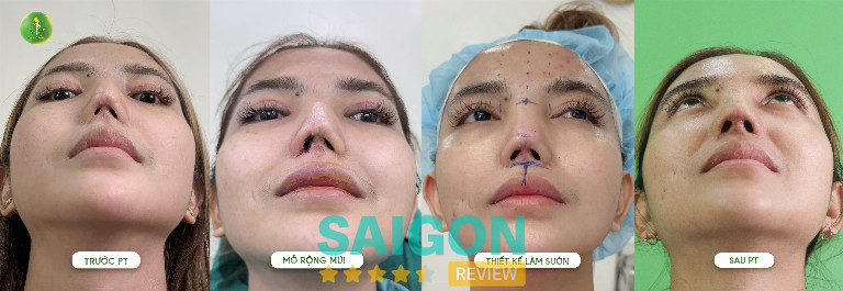 bác sĩ phẫu thuật sửa mũi hỏng tại TPHCM