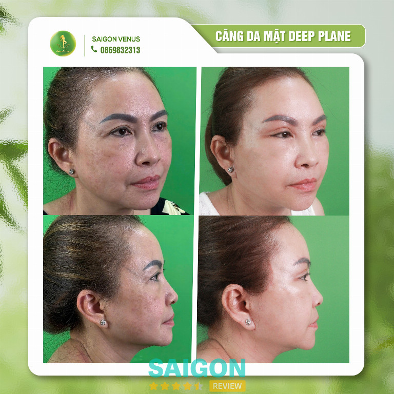 căng da mặt TPHCM