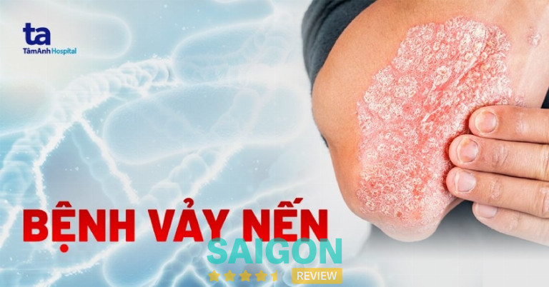 chữa bệnh vảy nến ở TPHCM 