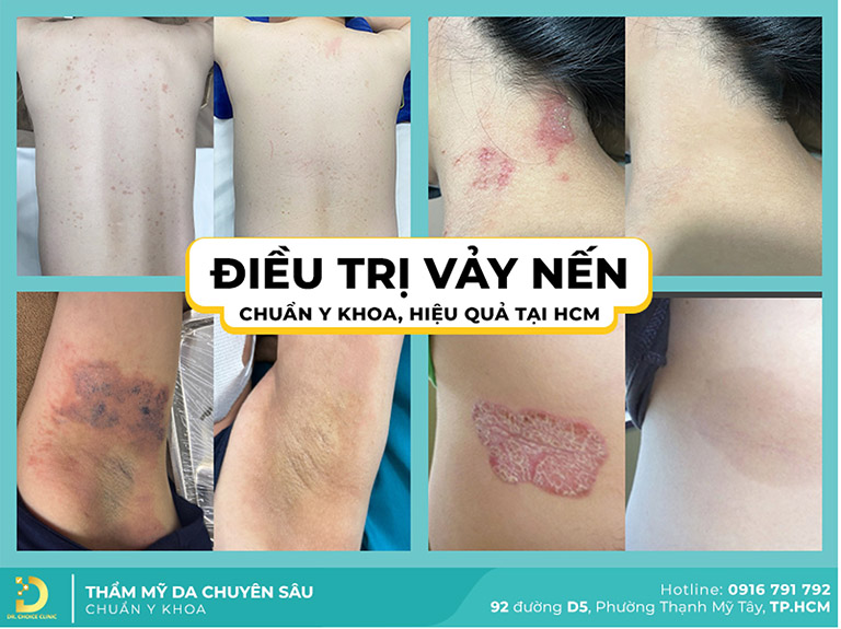 Dr choice clinic chữa vảy nến hiệu quả tphcm