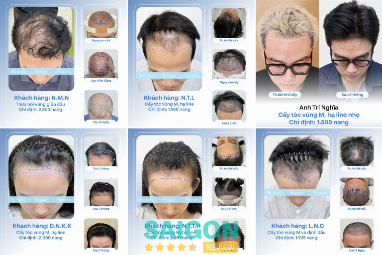 Viện Cấy Tóc NEWHAIR Viện Cấy Tóc NEWHAIR
