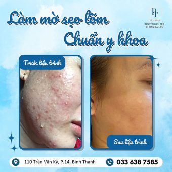 PT Beauty Dr Thanh trị sẹo ở Gò Vấp uy tín