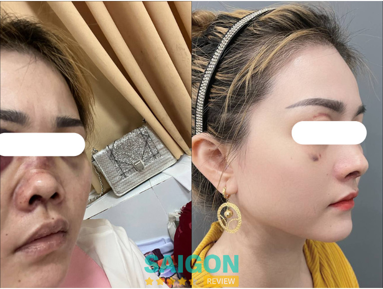 Kết quả sửa mũi hỏng do Bác sĩ CKI Đỗ Quang Khải thực hiện