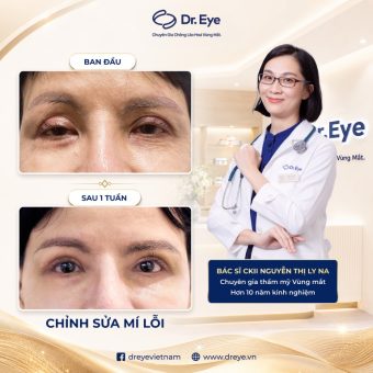 Địa chỉ sửa mí mắt hỏng tại TPHCM