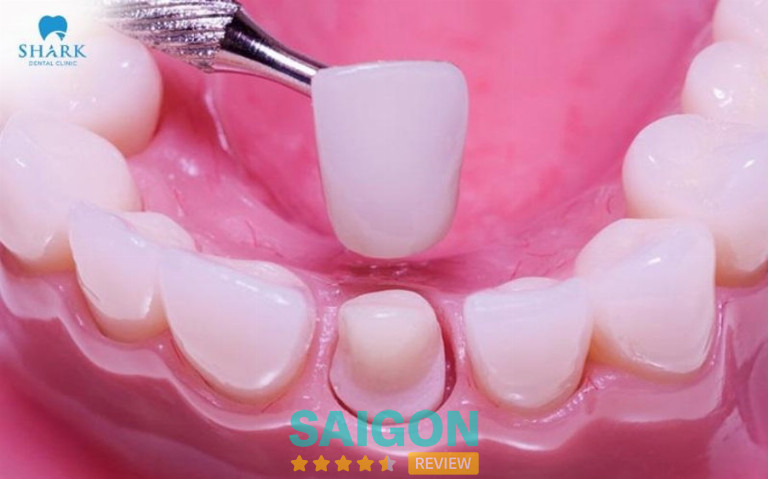 Bọc răng sứ là phương pháp phục hình thẩm mỹ trong nha khoa, giúp cải thiện hình dáng và màu sắc của răng hiệu quả