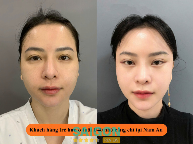 Khách hàng căng chỉ an toàn tại bệnh viện Nam An