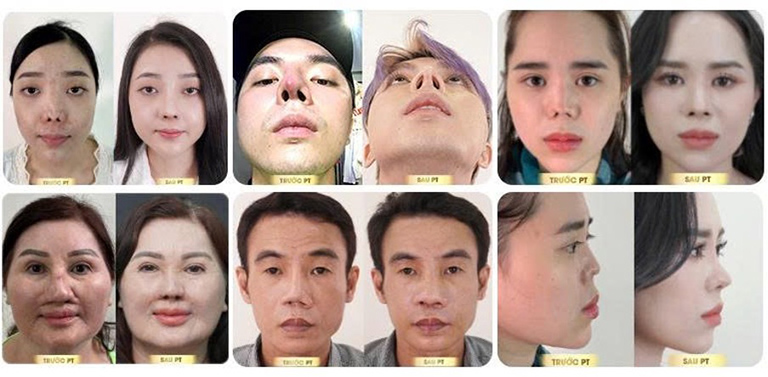 Nâng mũi việt kiều tphcm