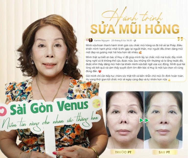 Nâng mũi việt kiều tphcm Sai Gon Venus