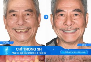 Vì sao Nha khoa Nhân Tâm được hàng chục ngàn khách hàng lựa chọn trồng răng Implant suốt 30 năm?