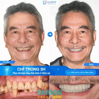 Khách hàng tự tin trở lại với nụ cười trọn vẹn sau khi trồng răng implant tại Nha khoa Nhân Tâm